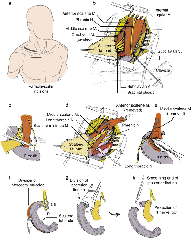 First rib resection: paraclavicular approach - Andreas M Lazaris, MD